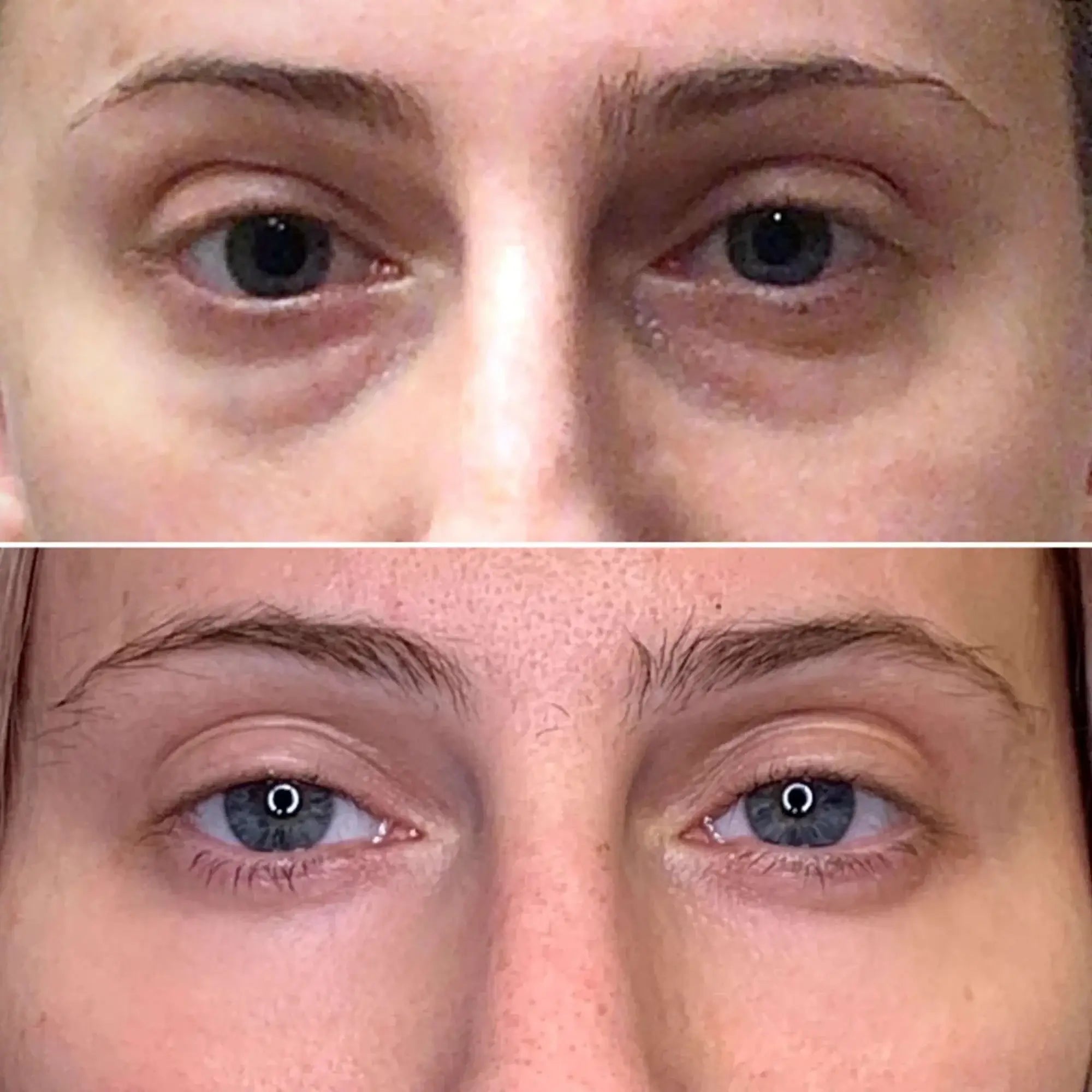 EyeFix: Filler – Beauty Fix MedSpa