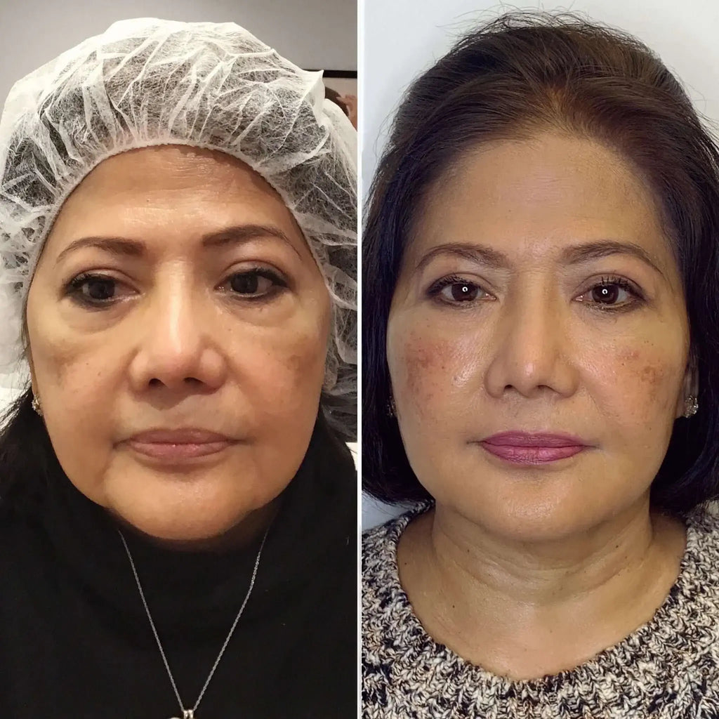 EyeFix: Filler – Beauty Fix MedSpa