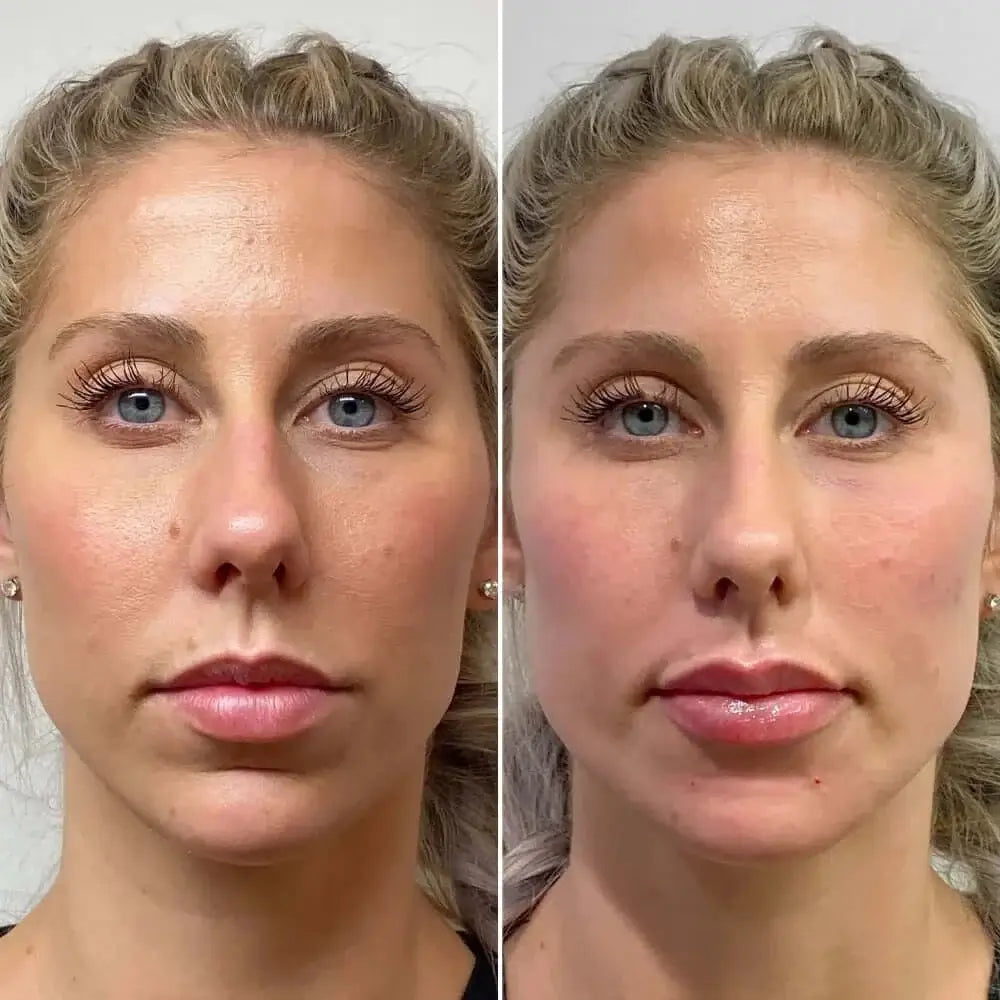 FaceFix: Sculptra – Beauty Fix MedSpa