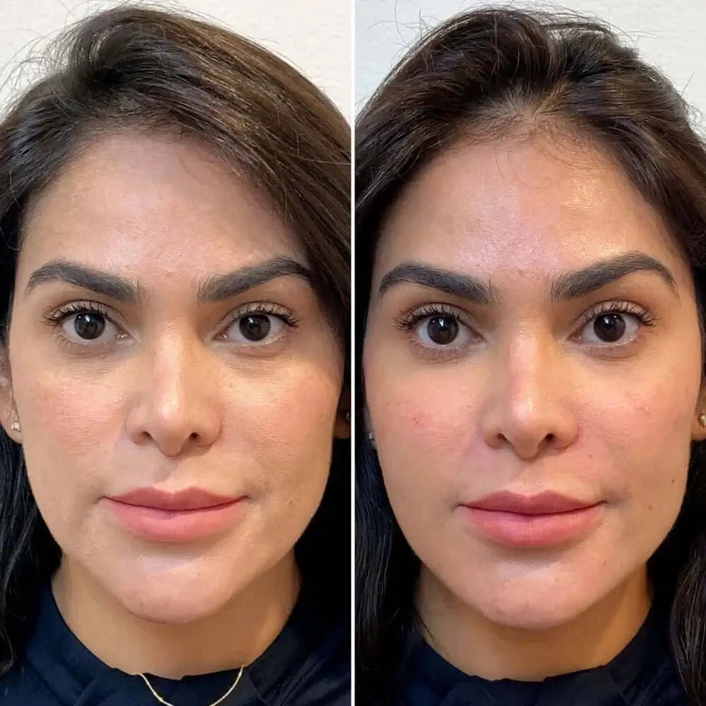 FaceFix: Sculptra – Beauty Fix MedSpa