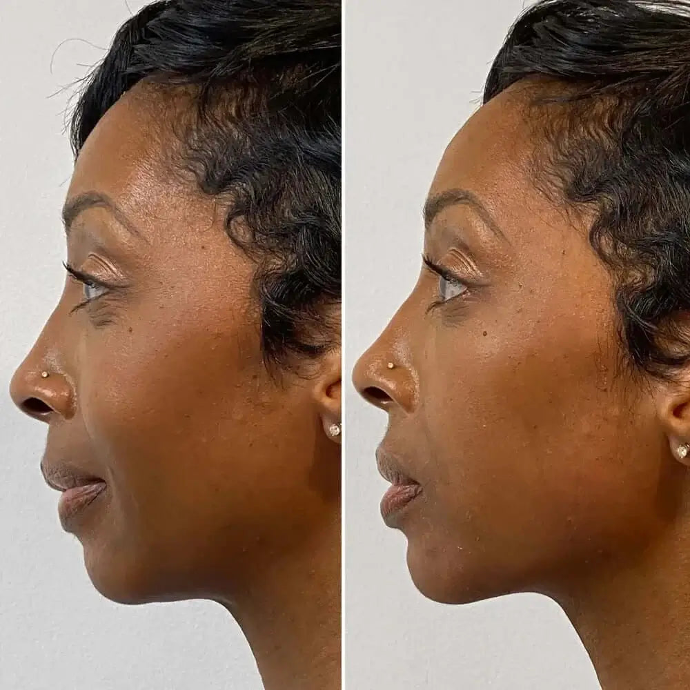 FaceFix: Sculptra – Beauty Fix MedSpa