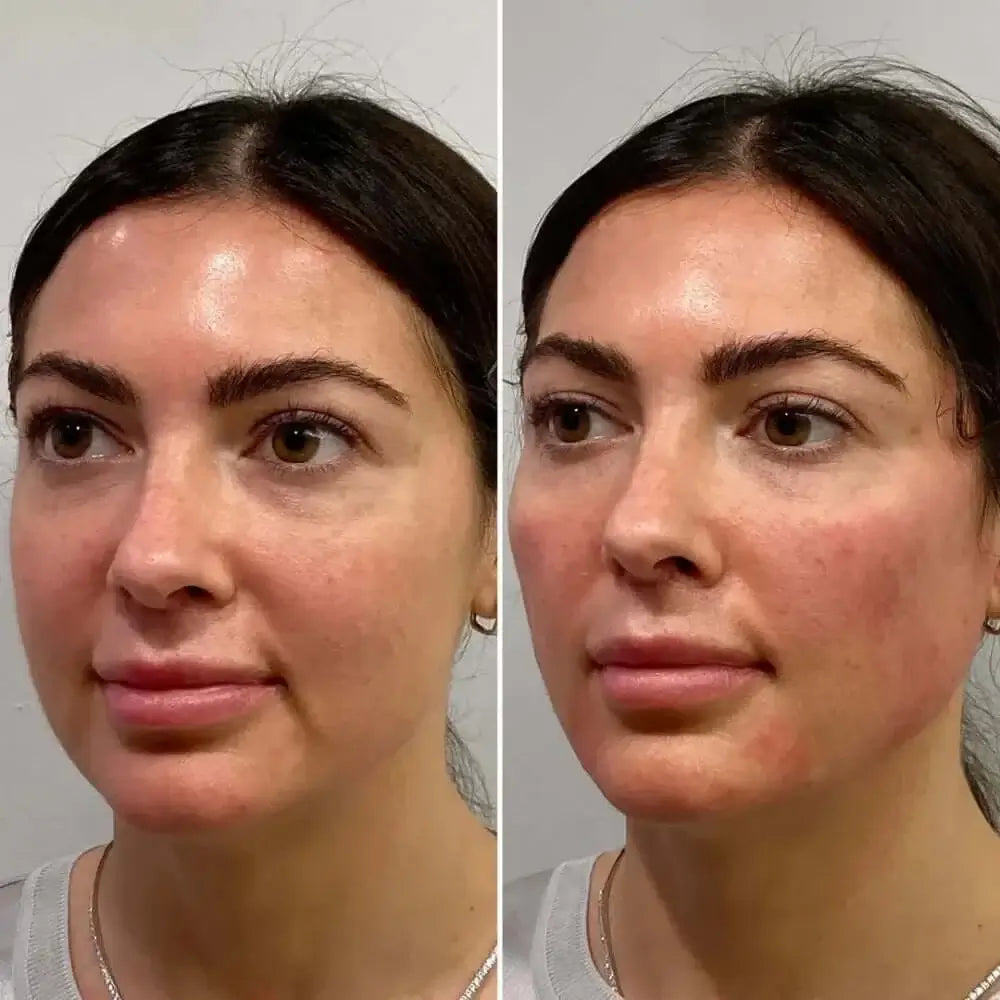 FaceFix: Sculptra – Beauty Fix MedSpa