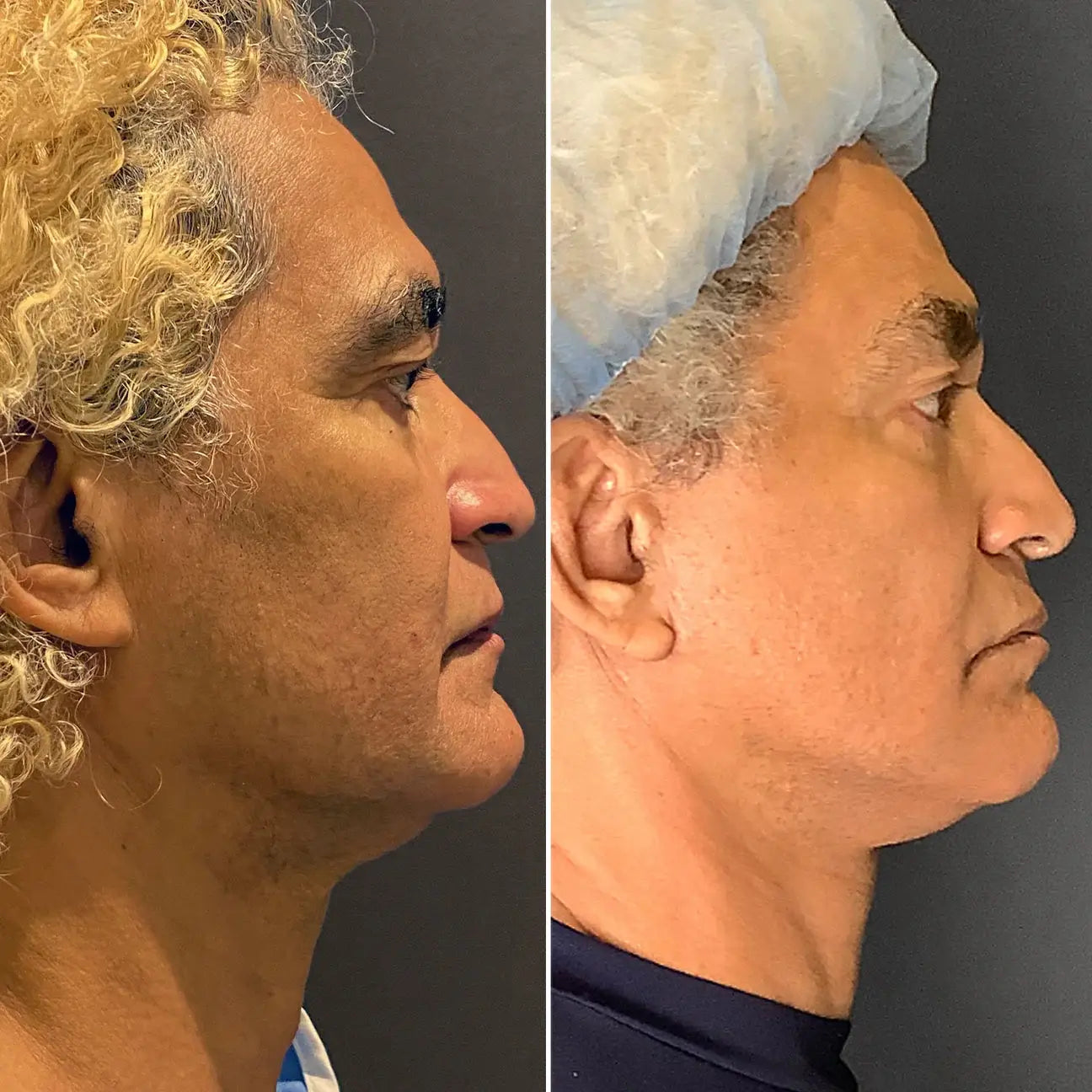 FaceFix: Face Lift – Beauty Fix MedSpa