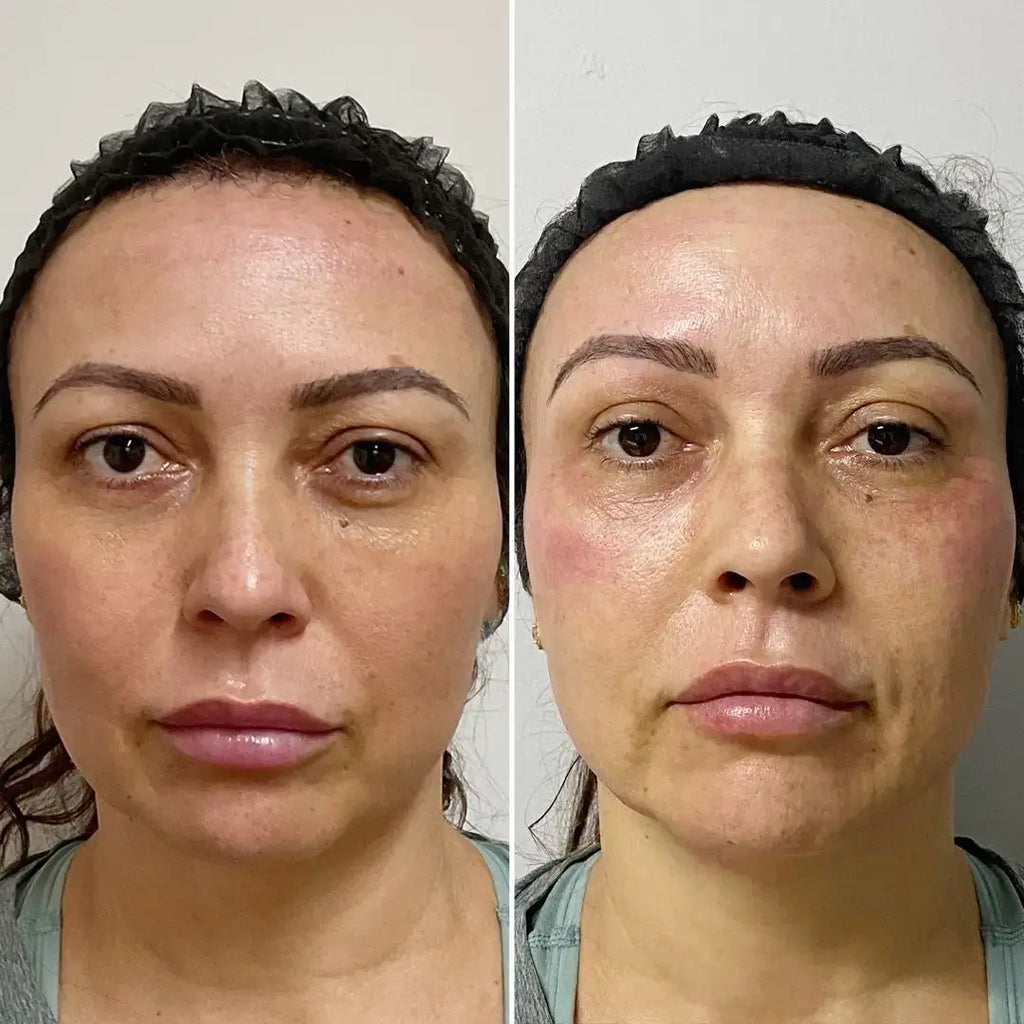 SkinFix: Resurfacing Facial – Beauty Fix MedSpa