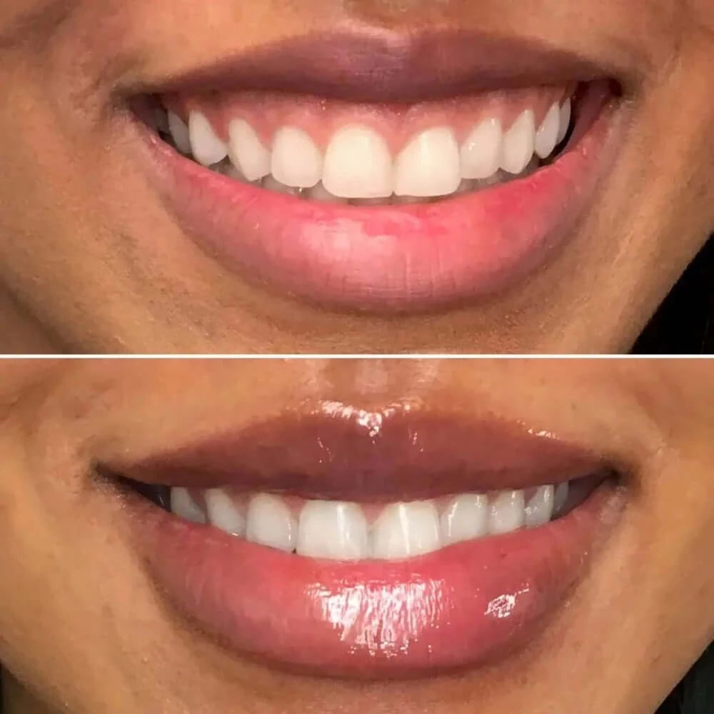 LipFix: Gummy Smile – Beauty Fix MedSpa