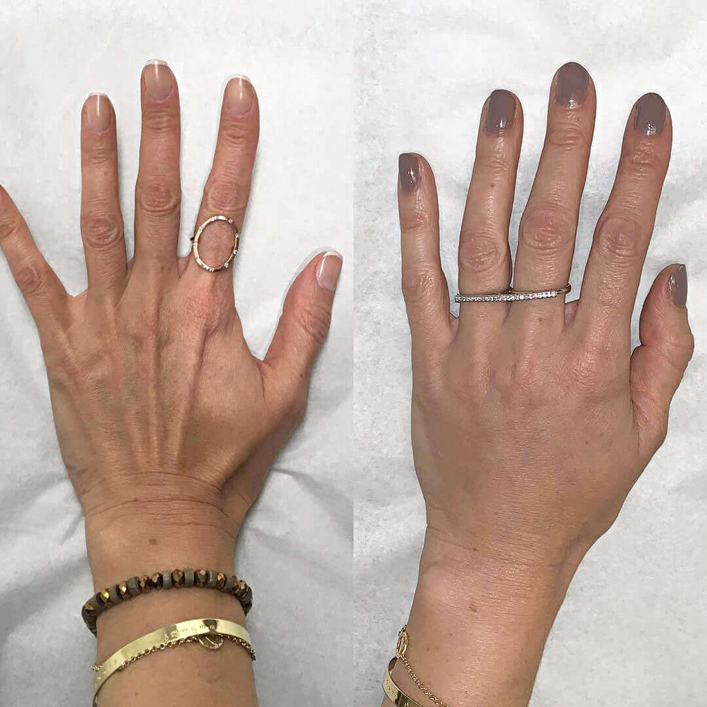 HandFix: Filler – Beauty Fix MedSpa