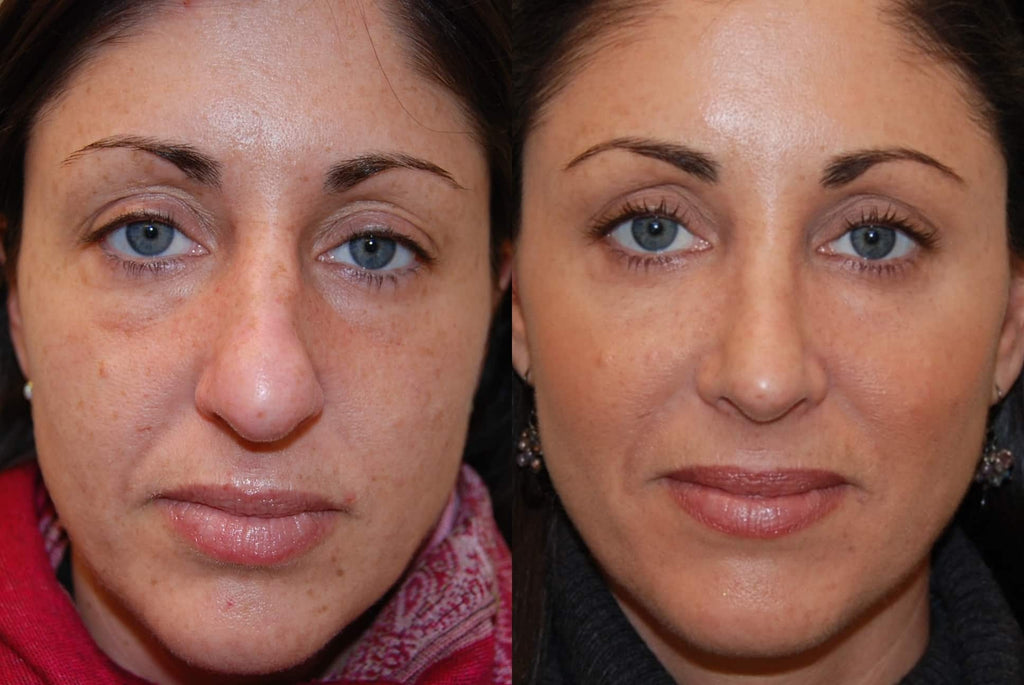 SkinFix: IPL – Beauty Fix MedSpa