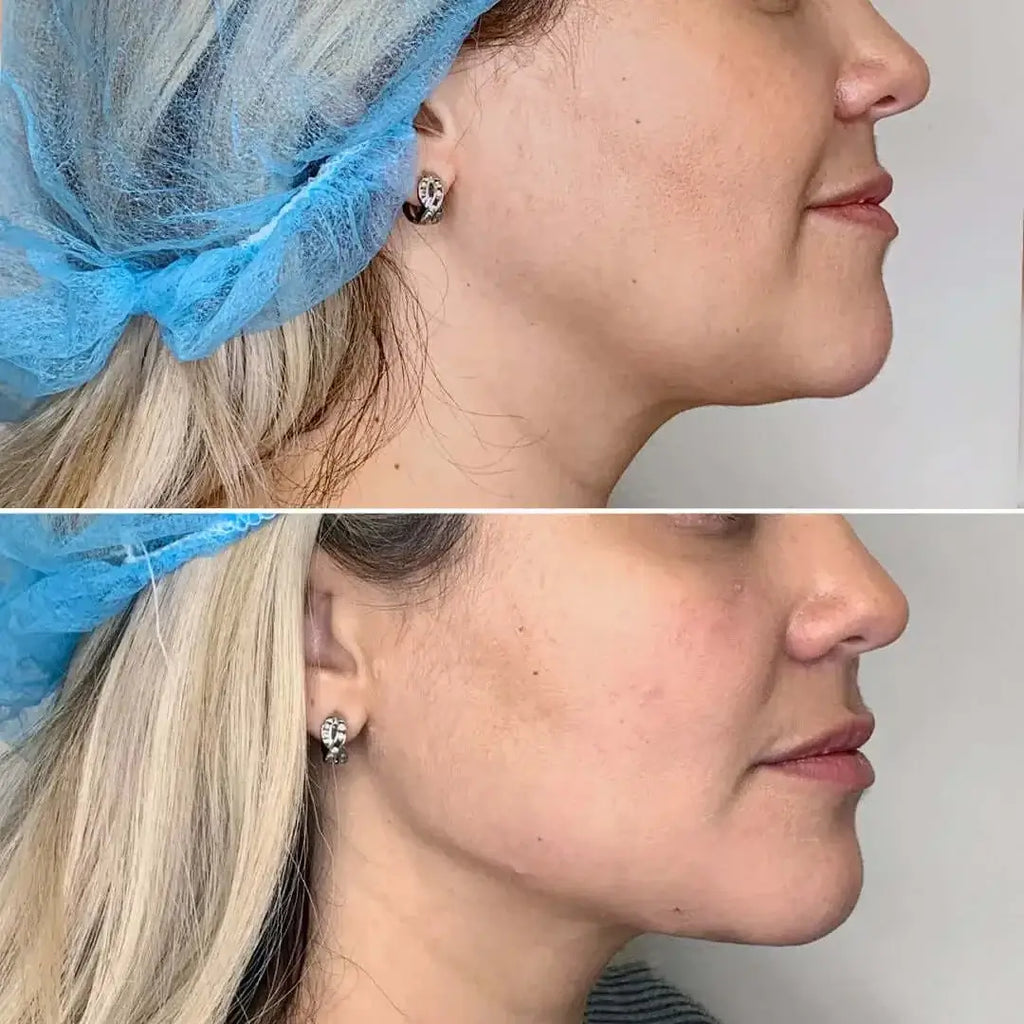 JawlineFix: Filler – Beauty Fix MedSpa