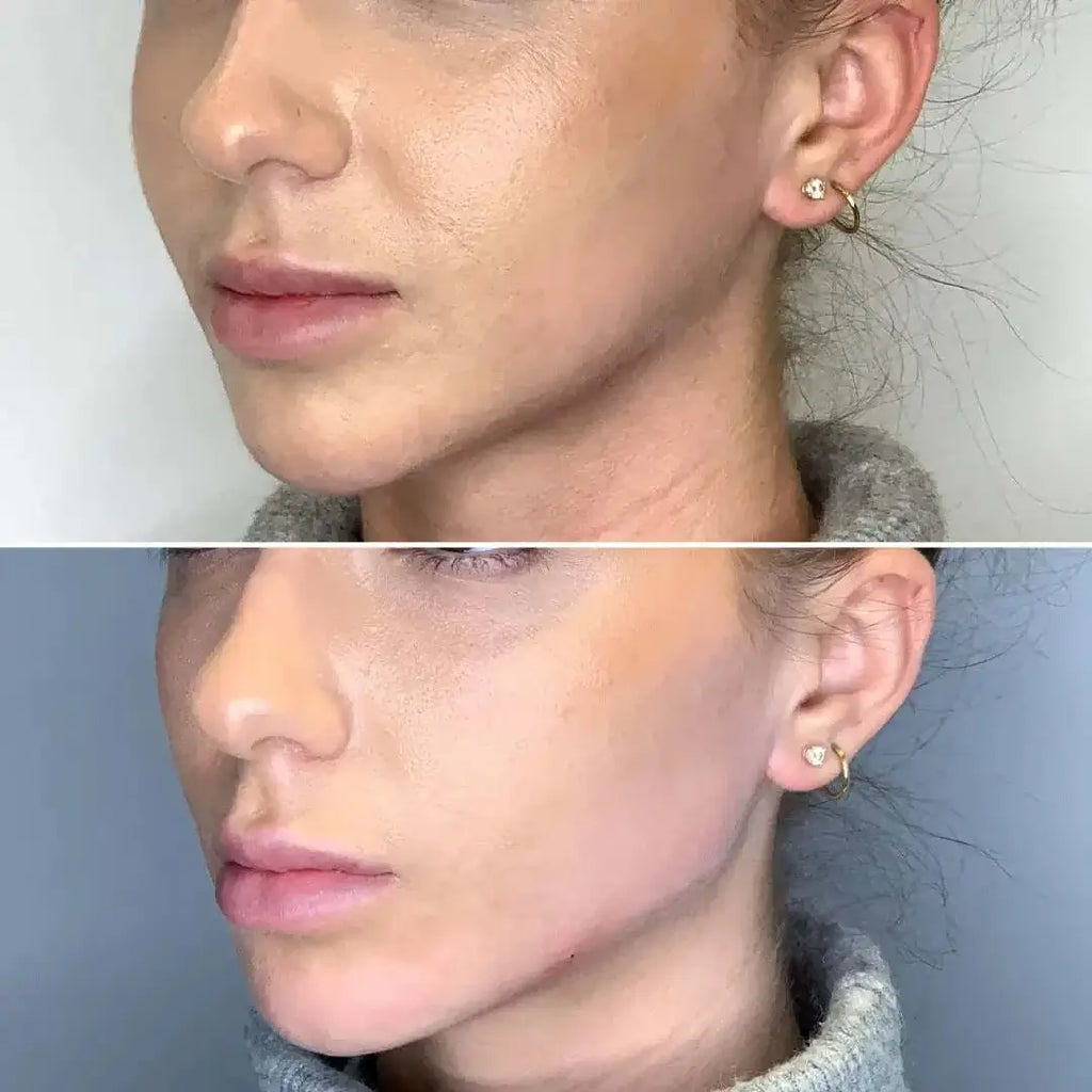 JawlineFix: Filler – Beauty Fix MedSpa