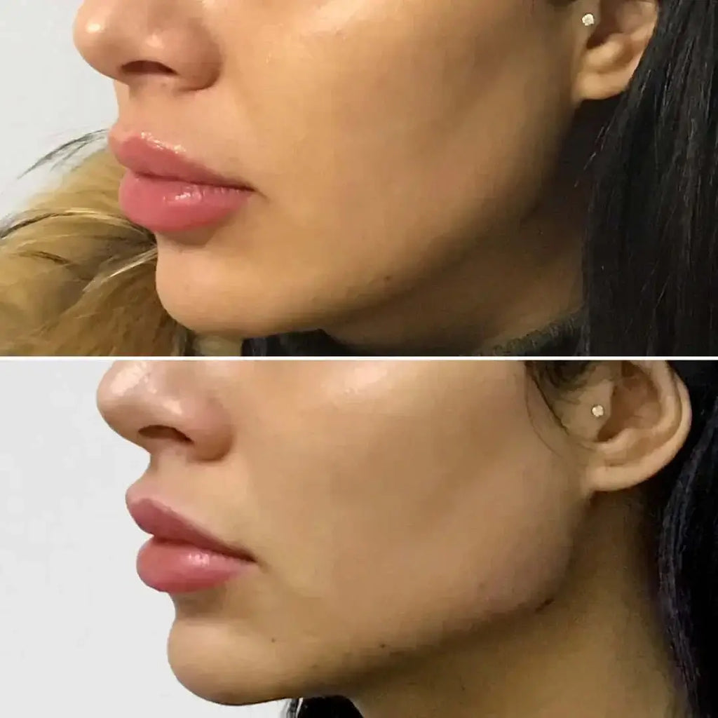 JawlineFix: Filler – Beauty Fix MedSpa