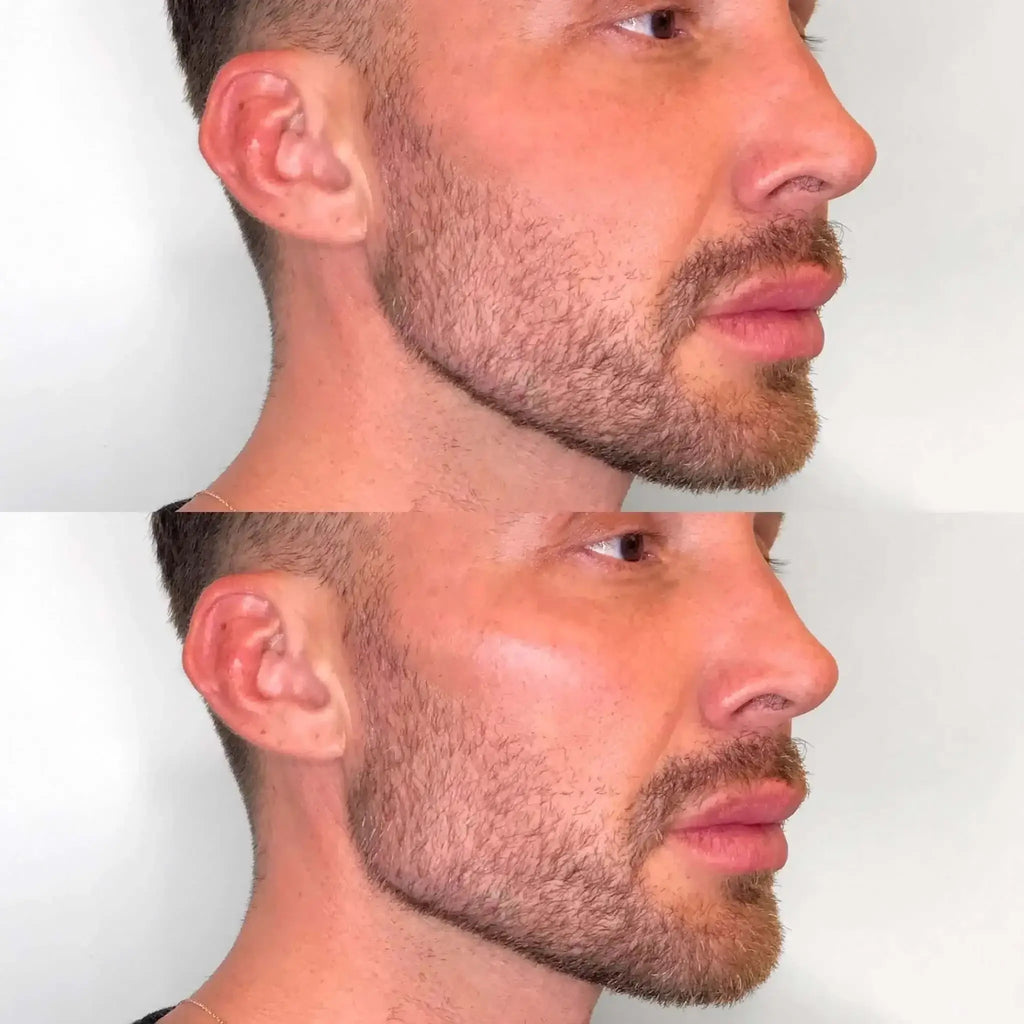 JawlineFix: Filler – Beauty Fix MedSpa