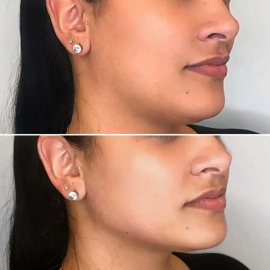 JawlineFix: Filler – Beauty Fix MedSpa