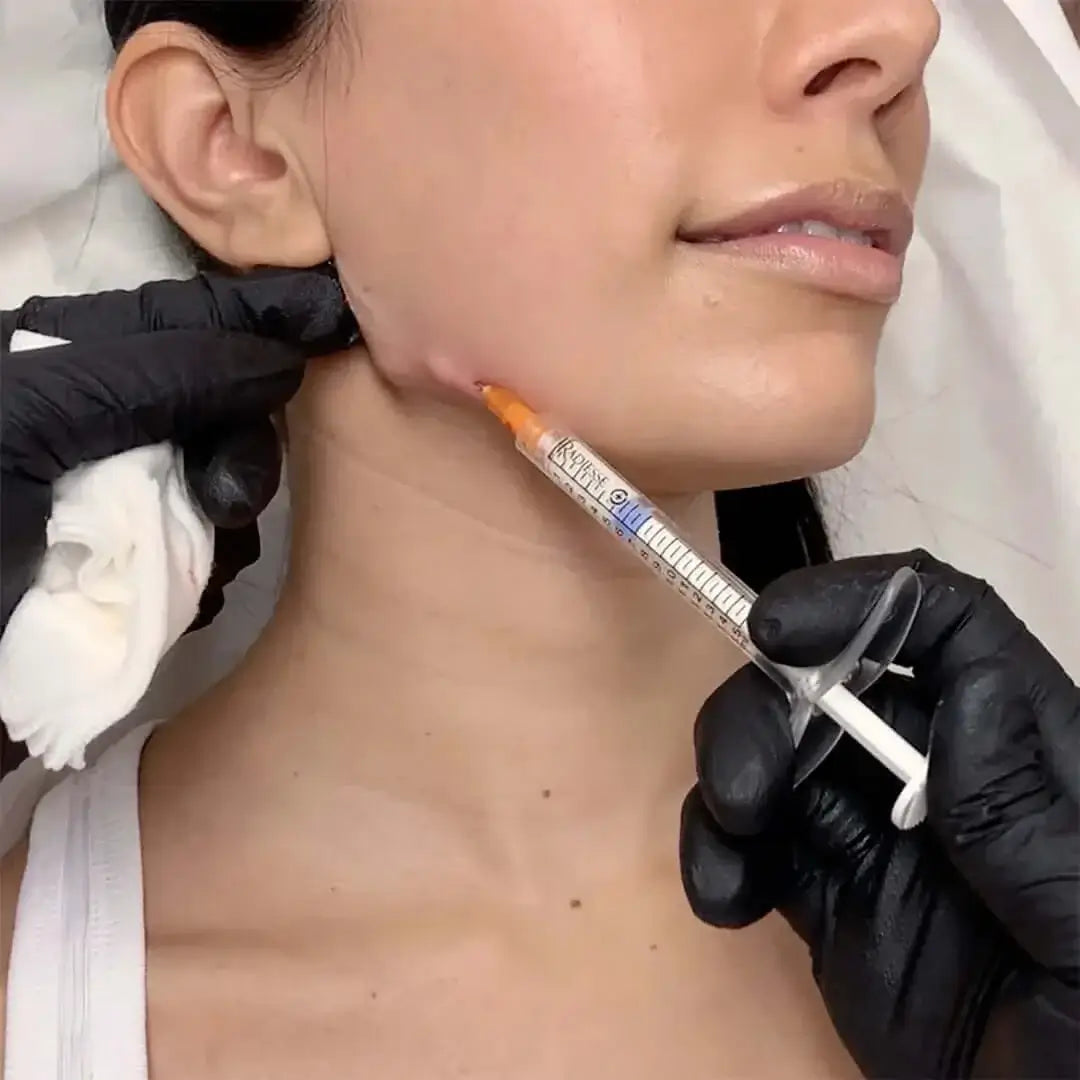 JawlineFix: Filler – Beauty Fix MedSpa