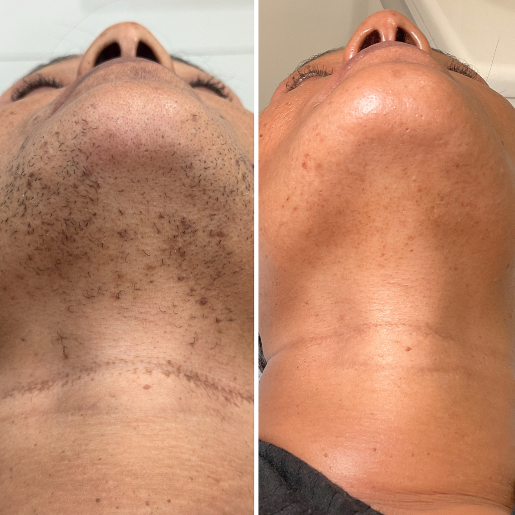 HairFix: Laser Hair Removal Small – Beauty Fix MedSpa