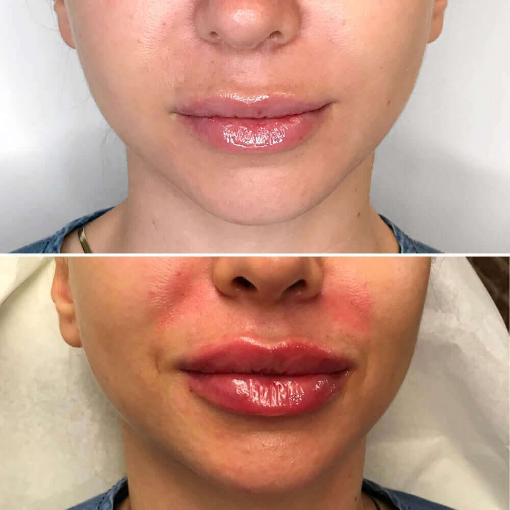 LipFix: Filler – Beauty Fix MedSpa