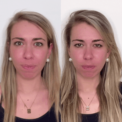 LipFix: Gummy Smile – Beauty Fix MedSpa