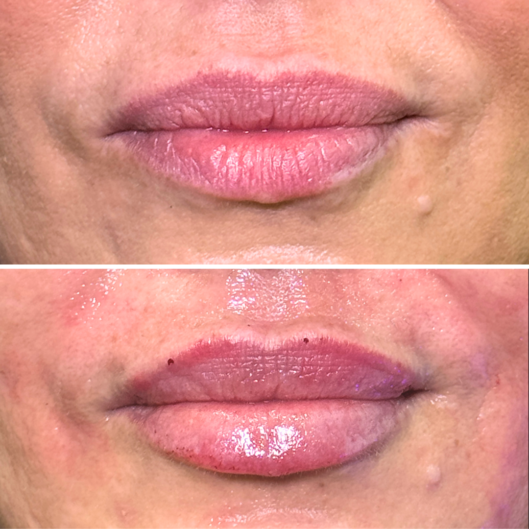 LipFix: Hydrate (SkinVive) – Beauty Fix MedSpa