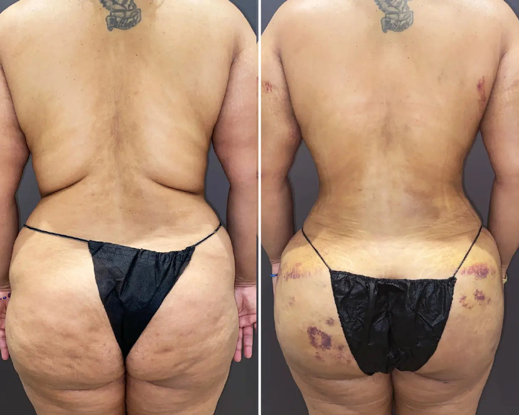 BootyFix: Brazilian Butt Lift (BBL) – Beauty Fix MedSpa