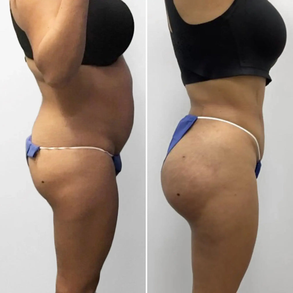 BootyFix: Brazilian Butt Lift (BBL) – Beauty Fix MedSpa