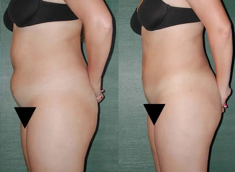 BodyFix: Liposuction – Beauty Fix MedSpa