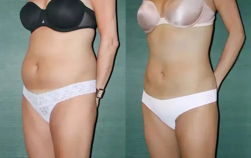 BodyFix: Liposuction – Beauty Fix MedSpa