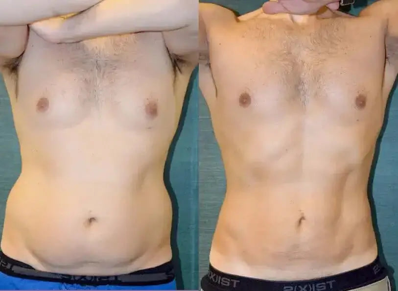 BodyFix: Liposuction – Beauty Fix MedSpa