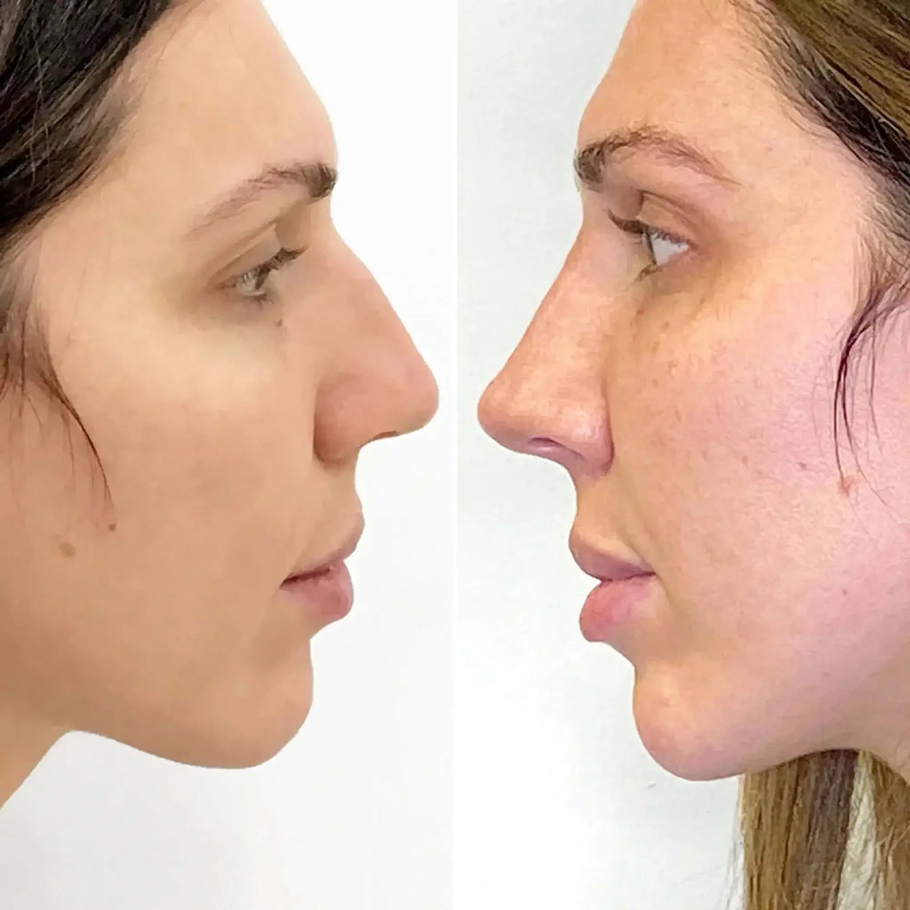 NoseFix: Filler – Beauty Fix MedSpa