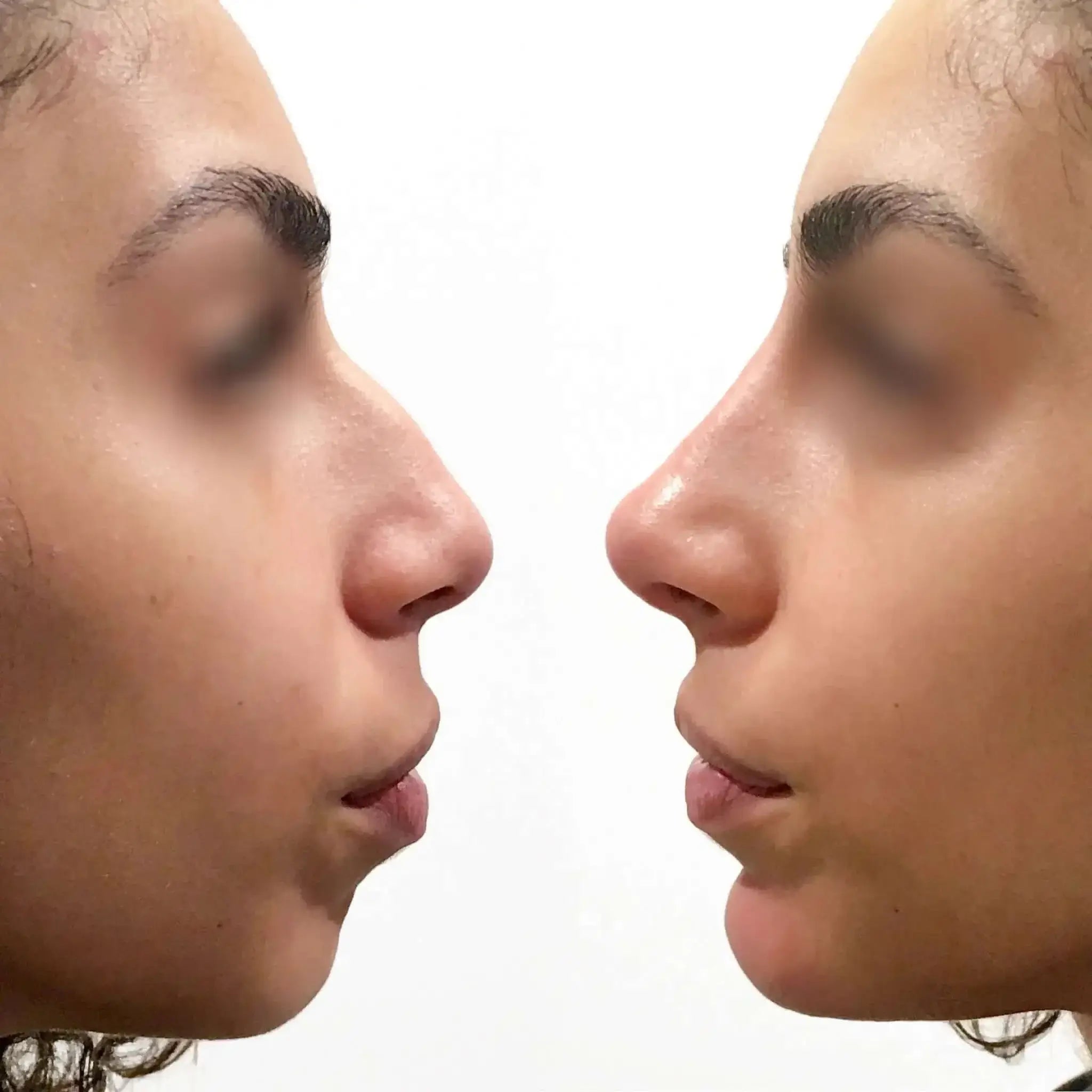 NoseFix: Filler – Beauty Fix MedSpa