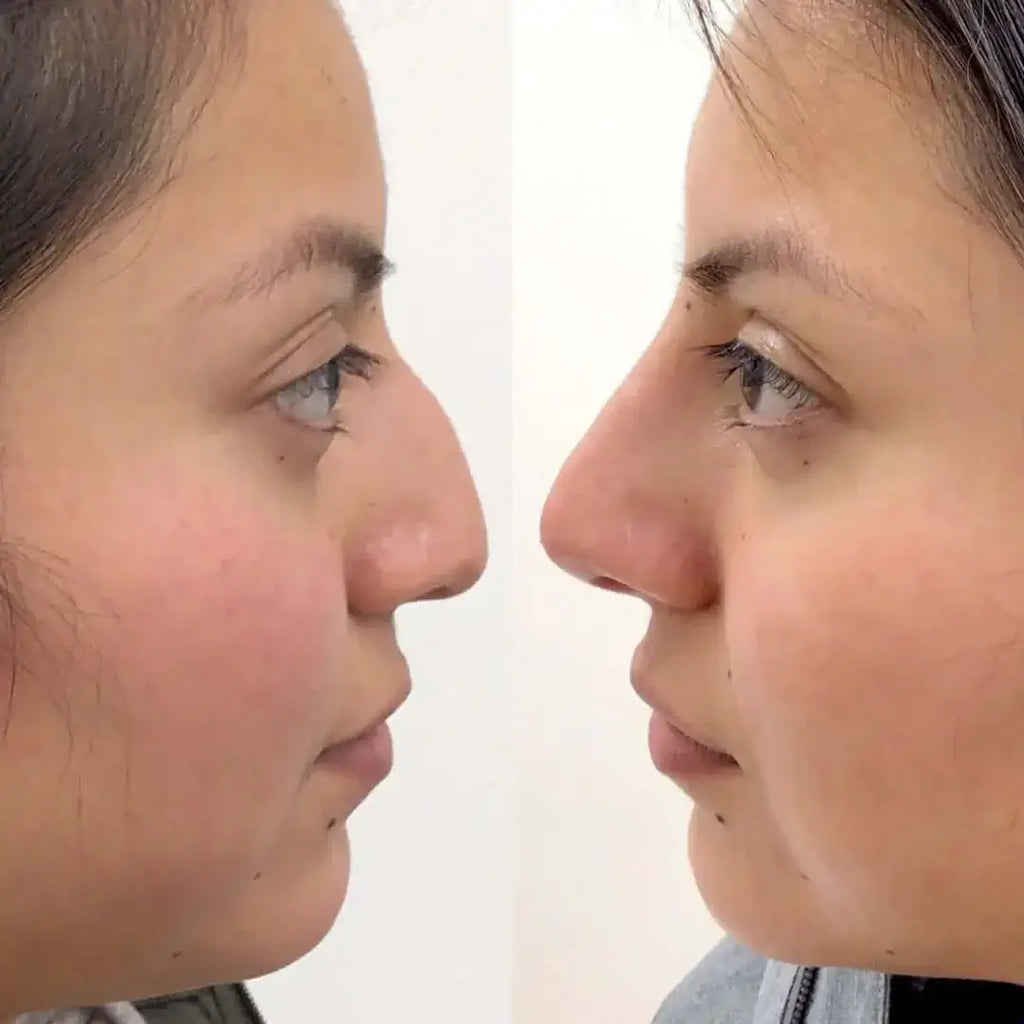 NoseFix: Filler – Beauty Fix MedSpa