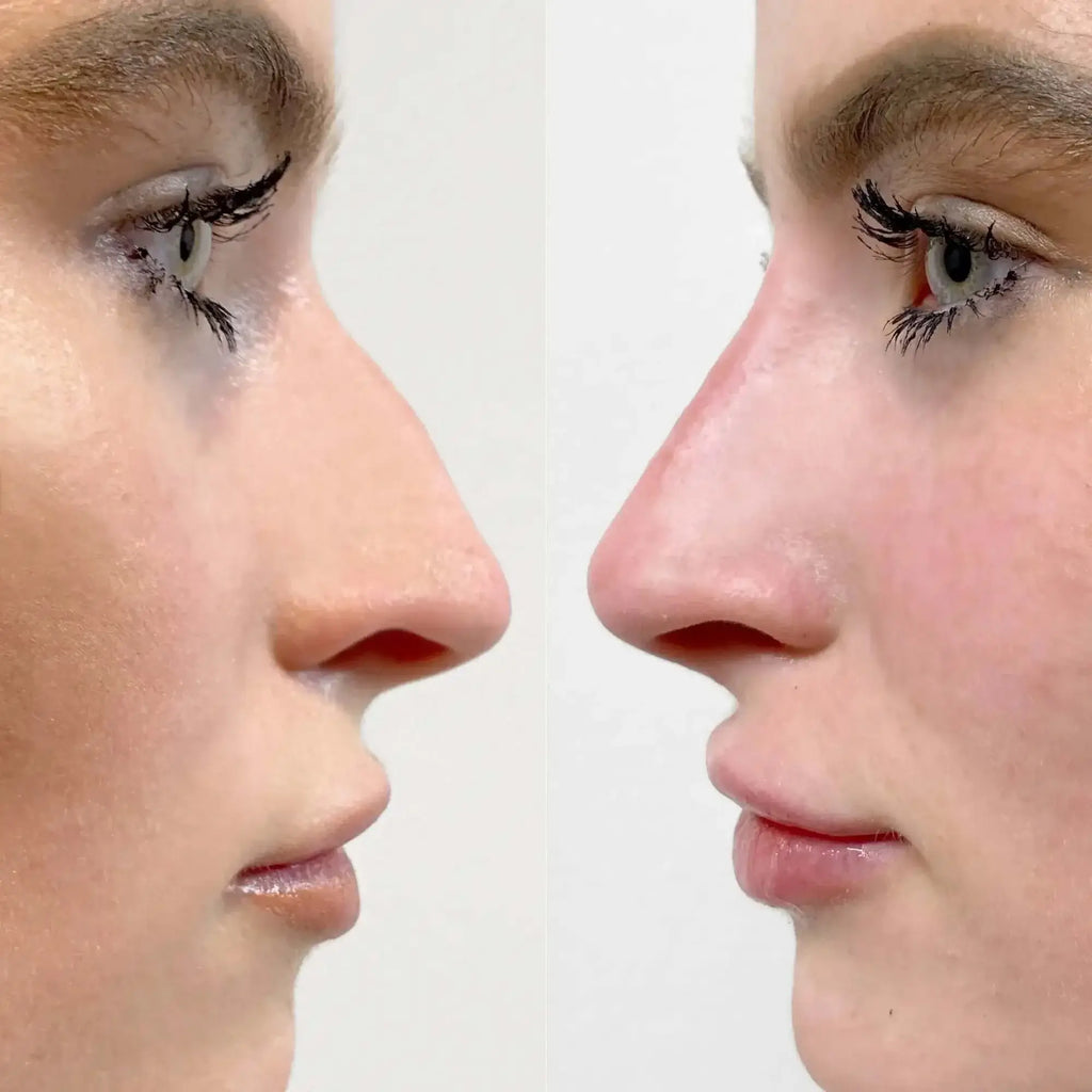 NoseFix: Filler – Beauty Fix MedSpa