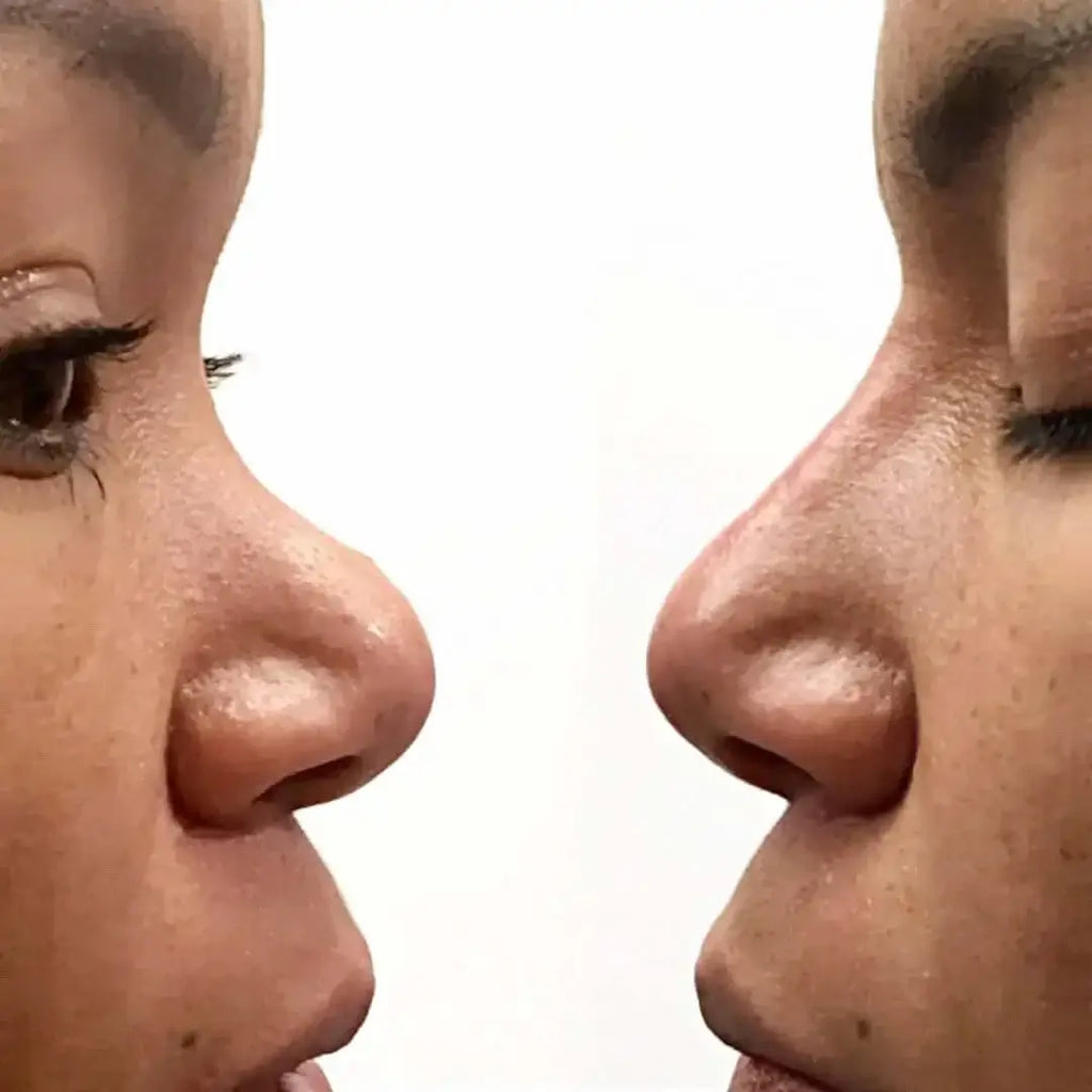 NoseFix: Filler – Beauty Fix MedSpa