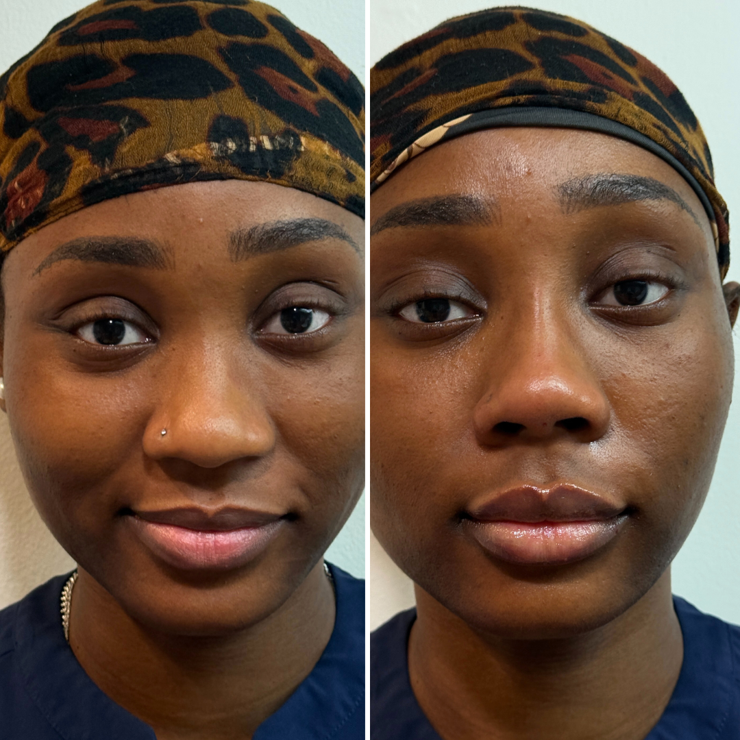 NoseFix: Slimming – Beauty Fix MedSpa