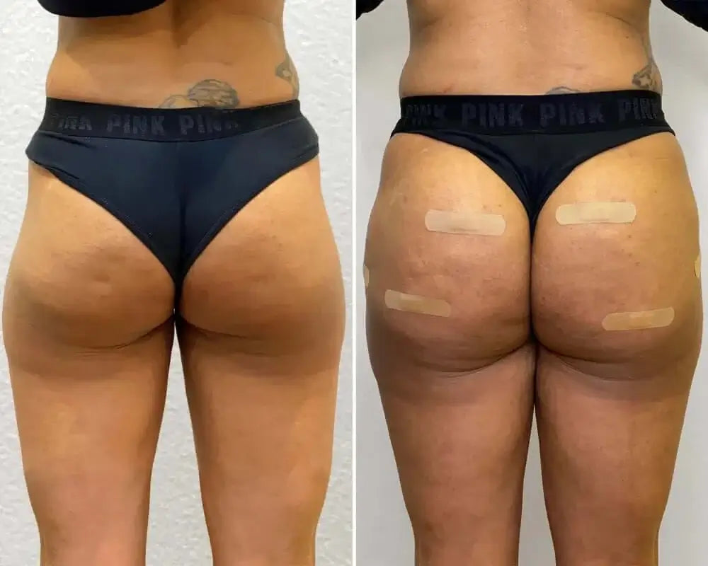 BootyFix: HipDips – Beauty Fix MedSpa