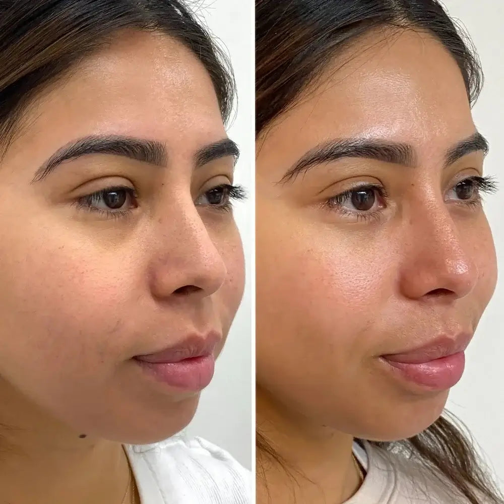 truSculpt fleX vs EMSculpt NEO - Miami Skin Spa