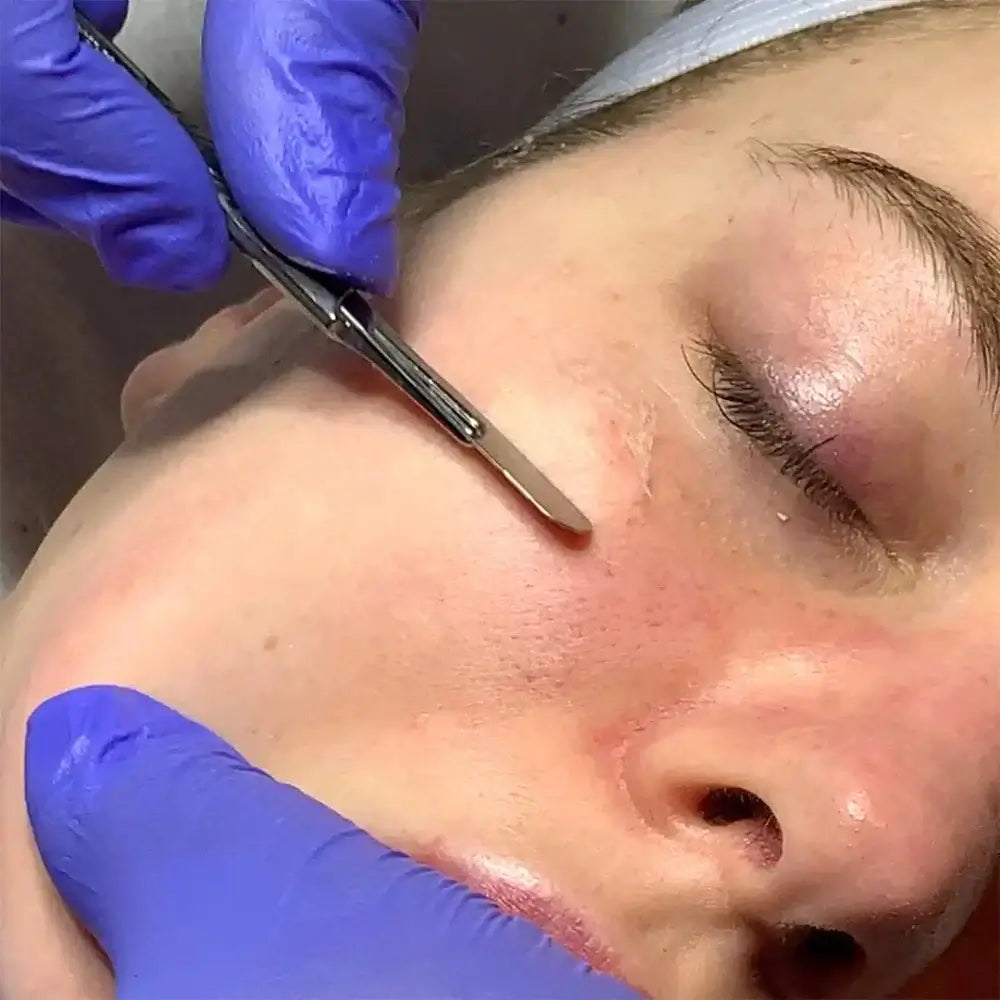 SkinFix: Dermaplaning – Beauty Fix MedSpa