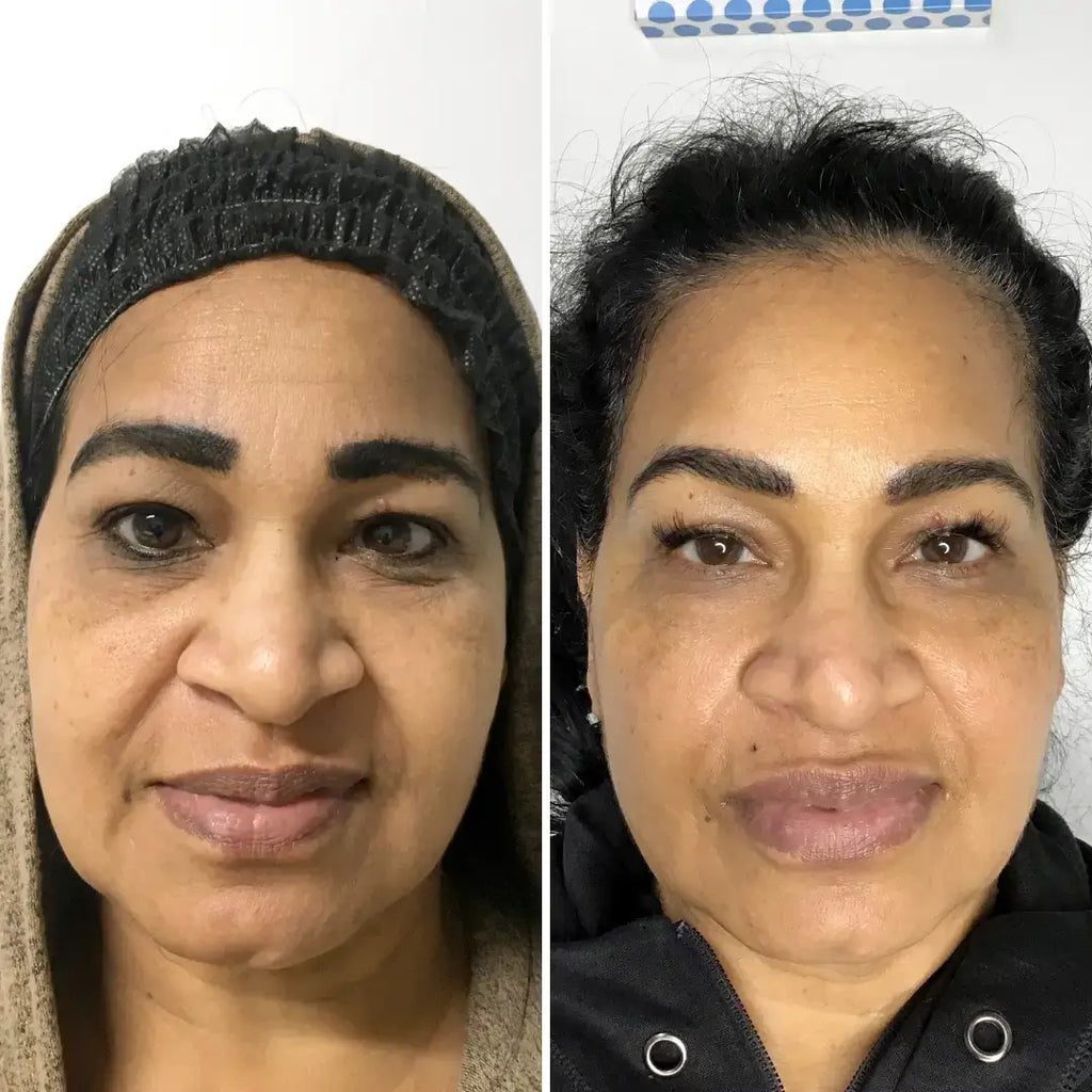 SkinFix: Resurfacing Facial – Beauty Fix MedSpa