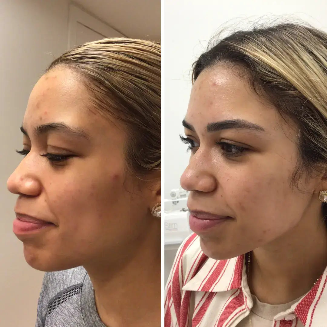 SkinFix: Microneedling – Beauty Fix MedSpa