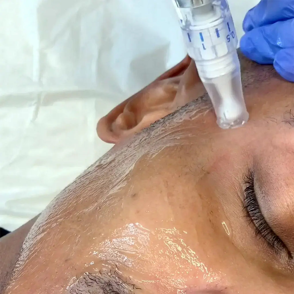 SkinFix: Microneedling – Beauty Fix MedSpa