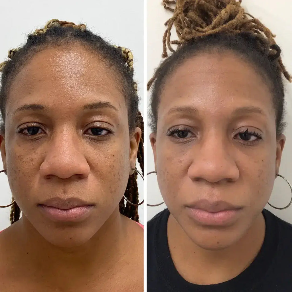 SkinFix: VI Peel – Beauty Fix MedSpa
