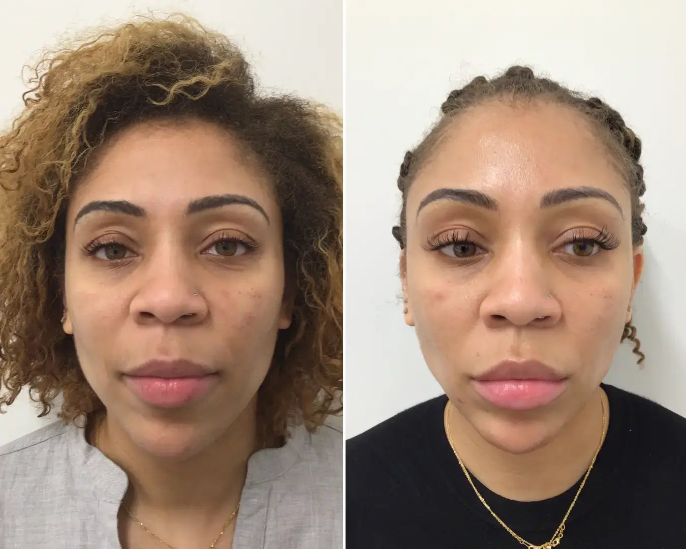 SkinFix: VI Peel – Beauty Fix MedSpa