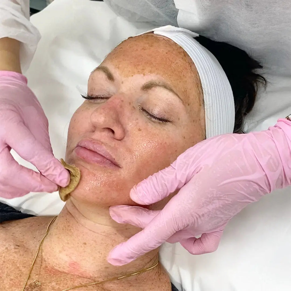 SkinFix: VI Peel – Beauty Fix MedSpa