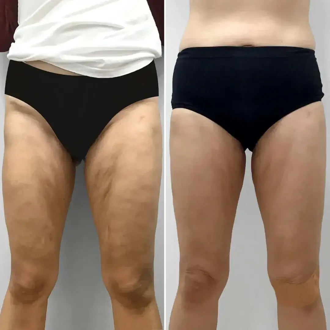 BodyFix: Morpheus8 – Beauty Fix MedSpa