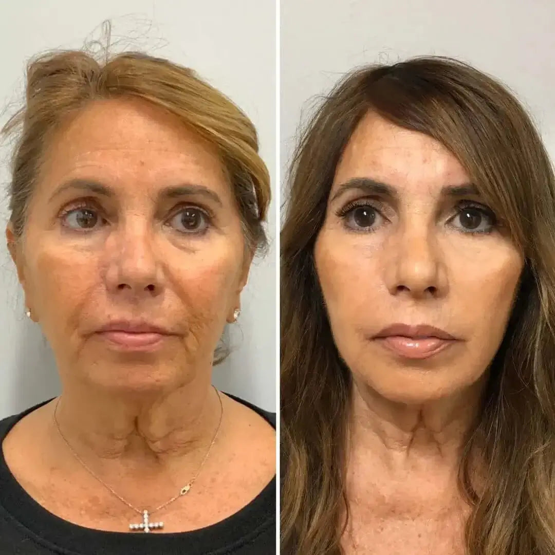 FaceFix: Thread Lift – Beauty Fix MedSpa