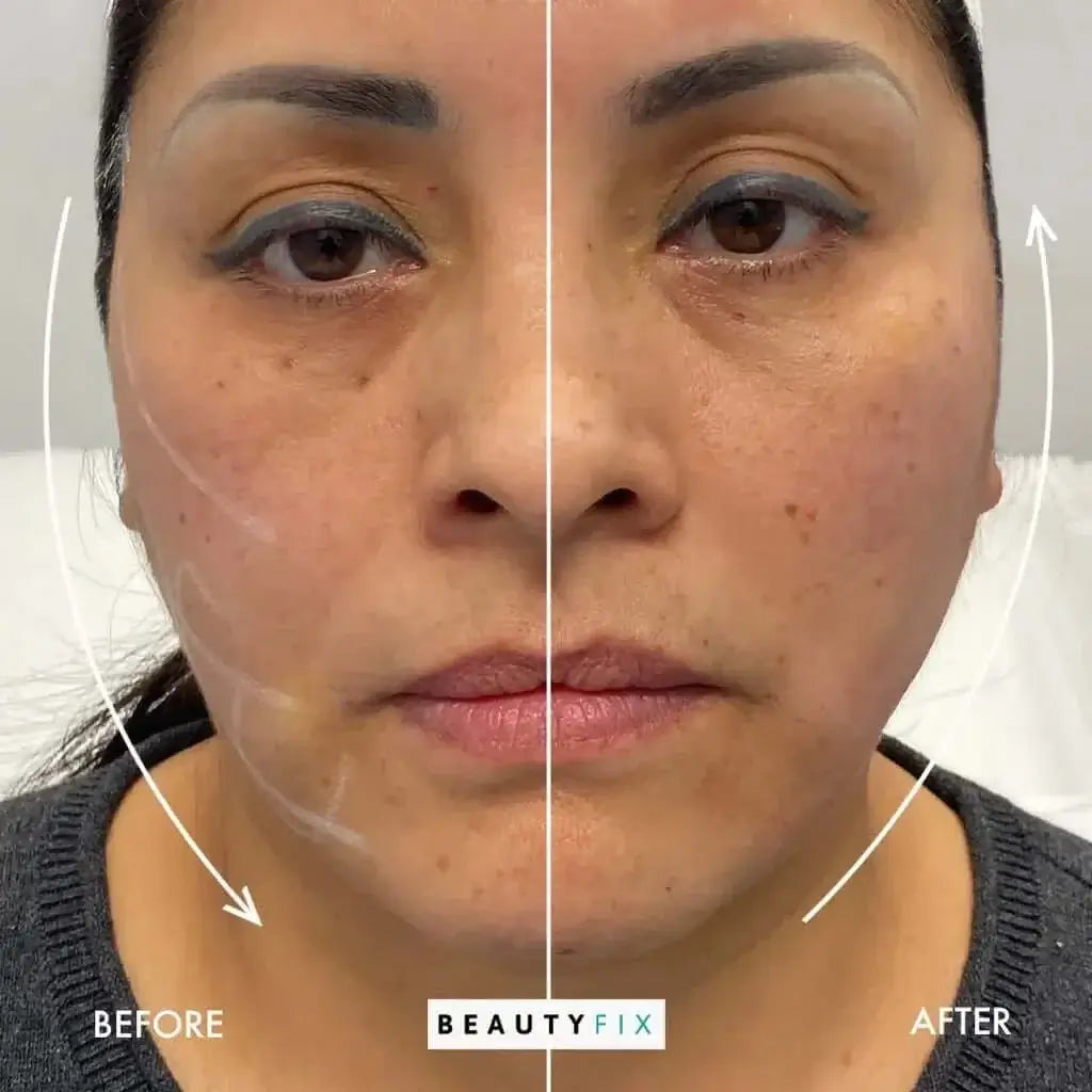 FaceFix: Thread Lift – Beauty Fix MedSpa