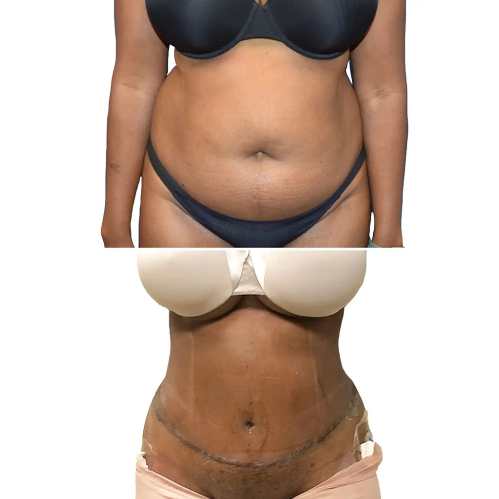 BodyFix: Tummy Tuck – Beauty Fix MedSpa