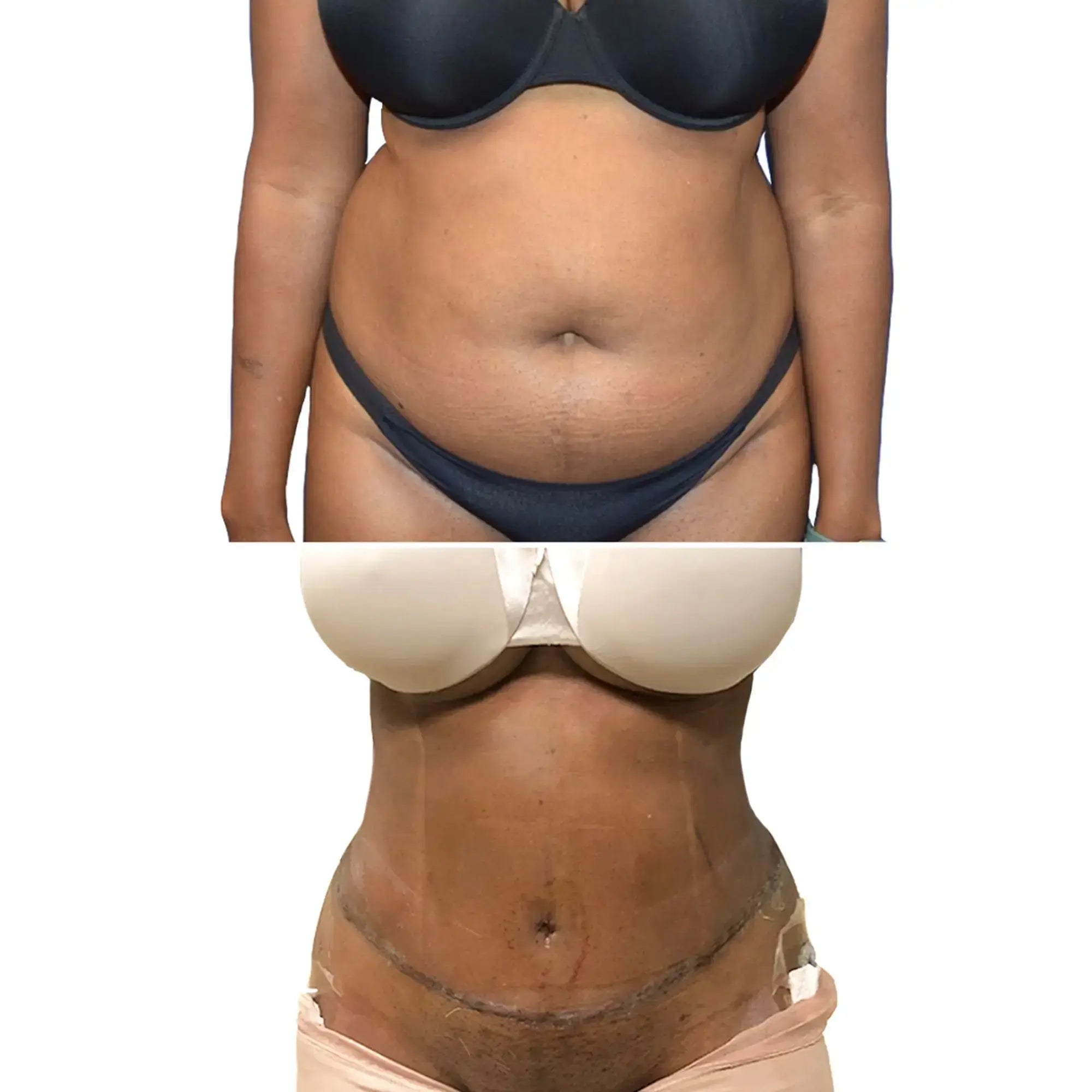 BodyFix: Tummy Tuck – Beauty Fix MedSpa