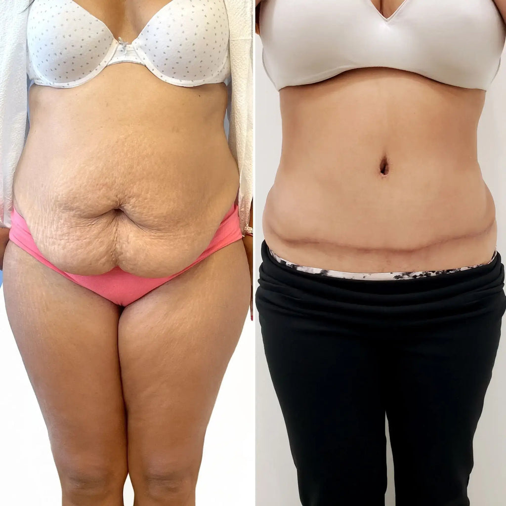 BodyFix: Tummy Tuck – Beauty Fix MedSpa