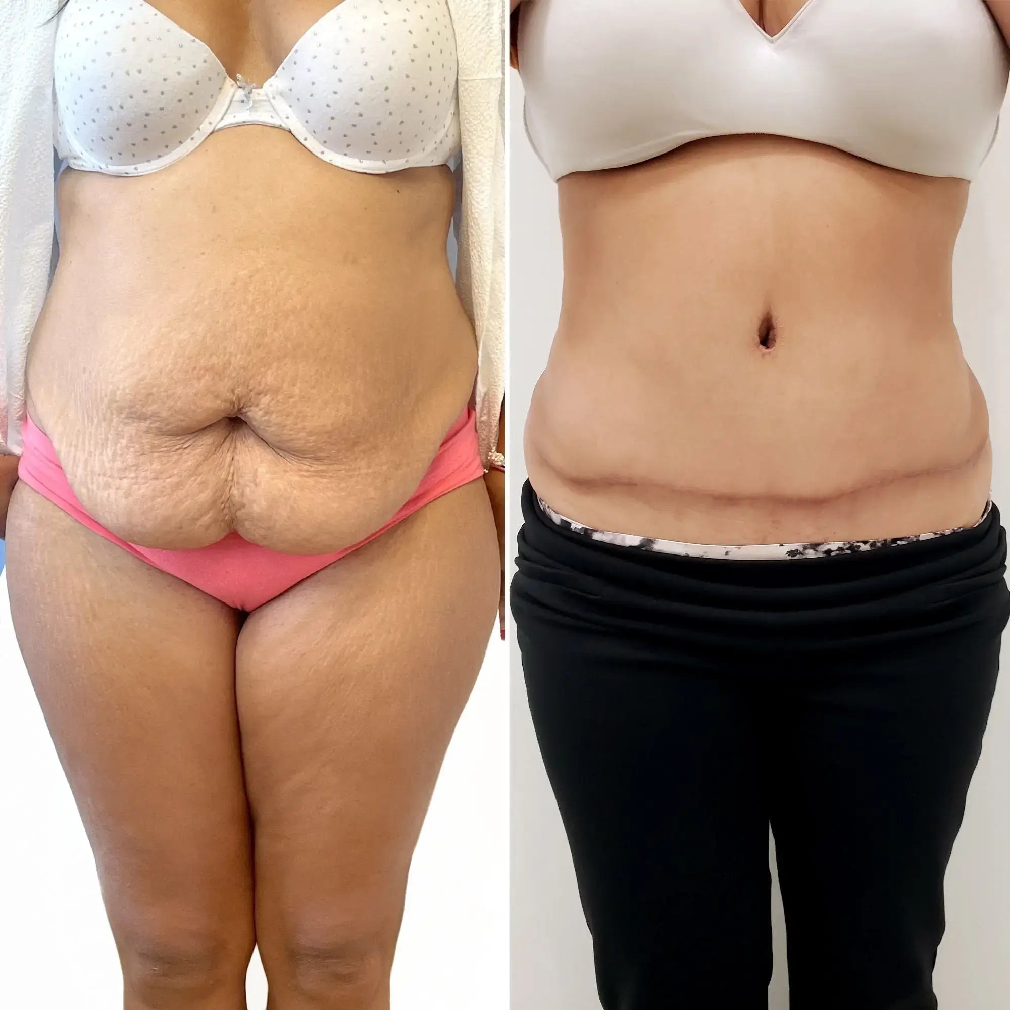BodyFix: Tummy Tuck – Beauty Fix MedSpa