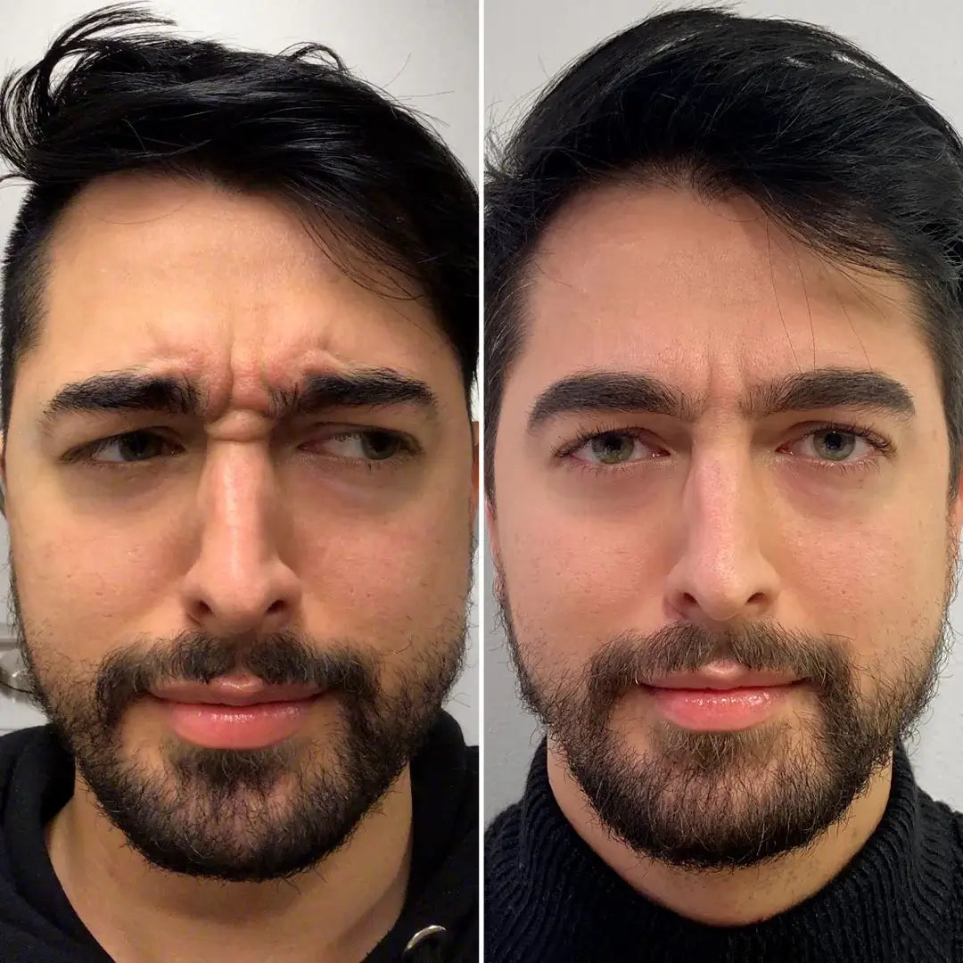 WrinkleFix: Botox (First-Time)