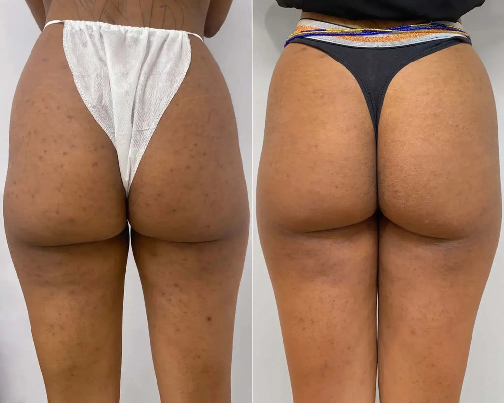 BootyFix: DSE Peel + Microneedling – Beauty Fix MedSpa